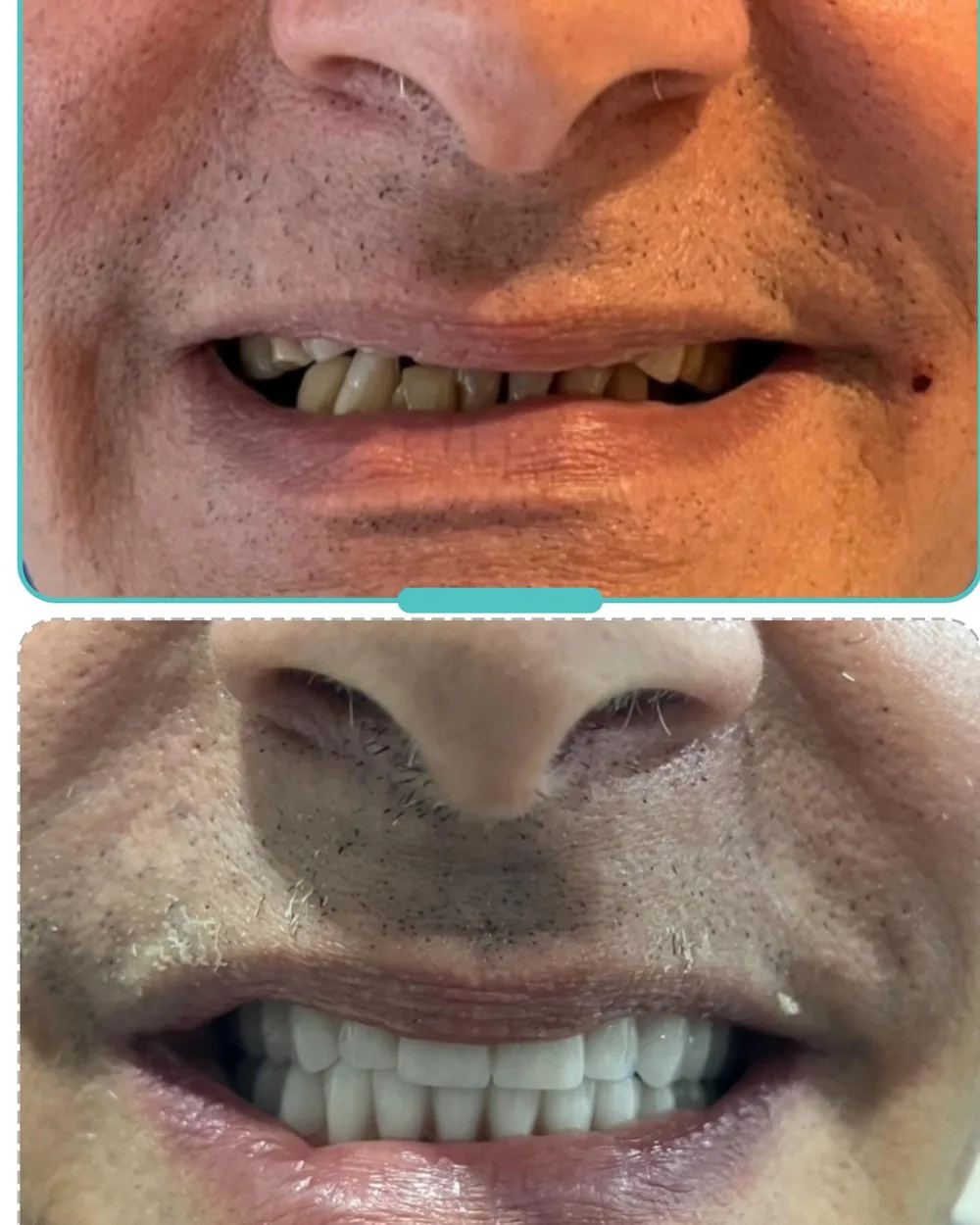 Antes e depois de paciente reabilitado com dentes fixos