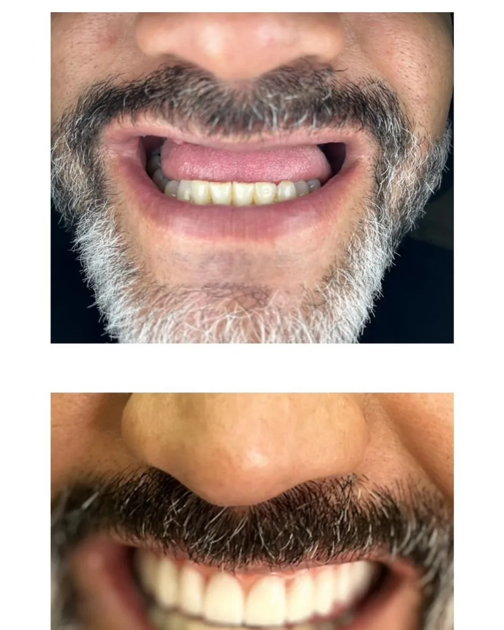 Paciente antes e depois da reabilitação com implantes