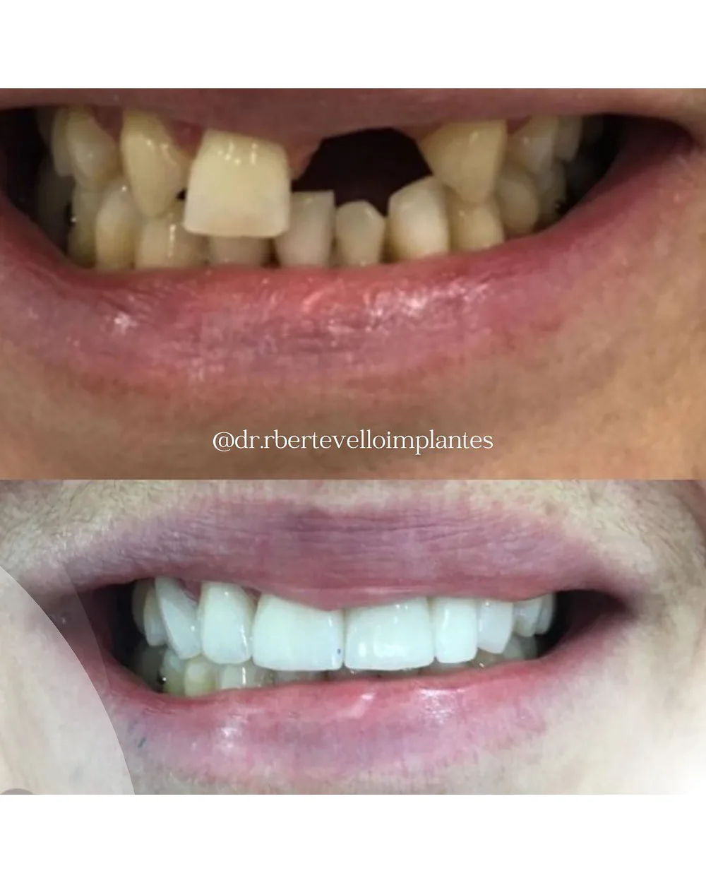 Sorriso de paciente antes e depois do tratamento com implantes
