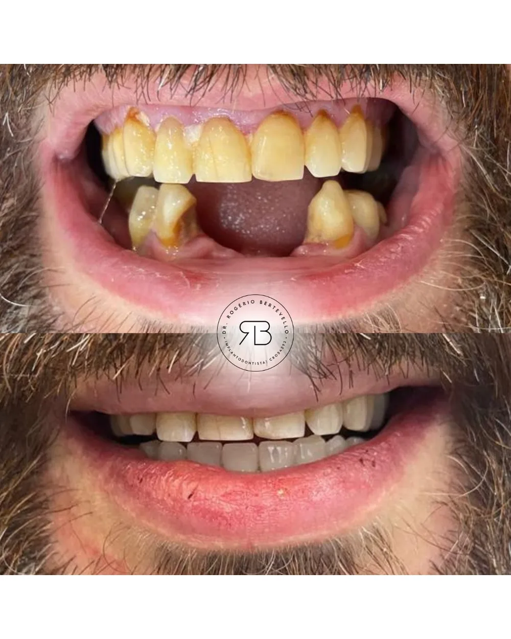 Paciente antes e depois dos dentes fixos sobre implantes