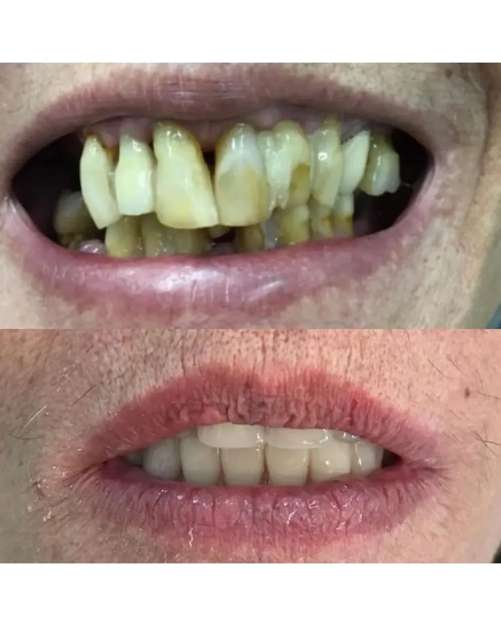 Transformação do sorriso com implantes dentários
