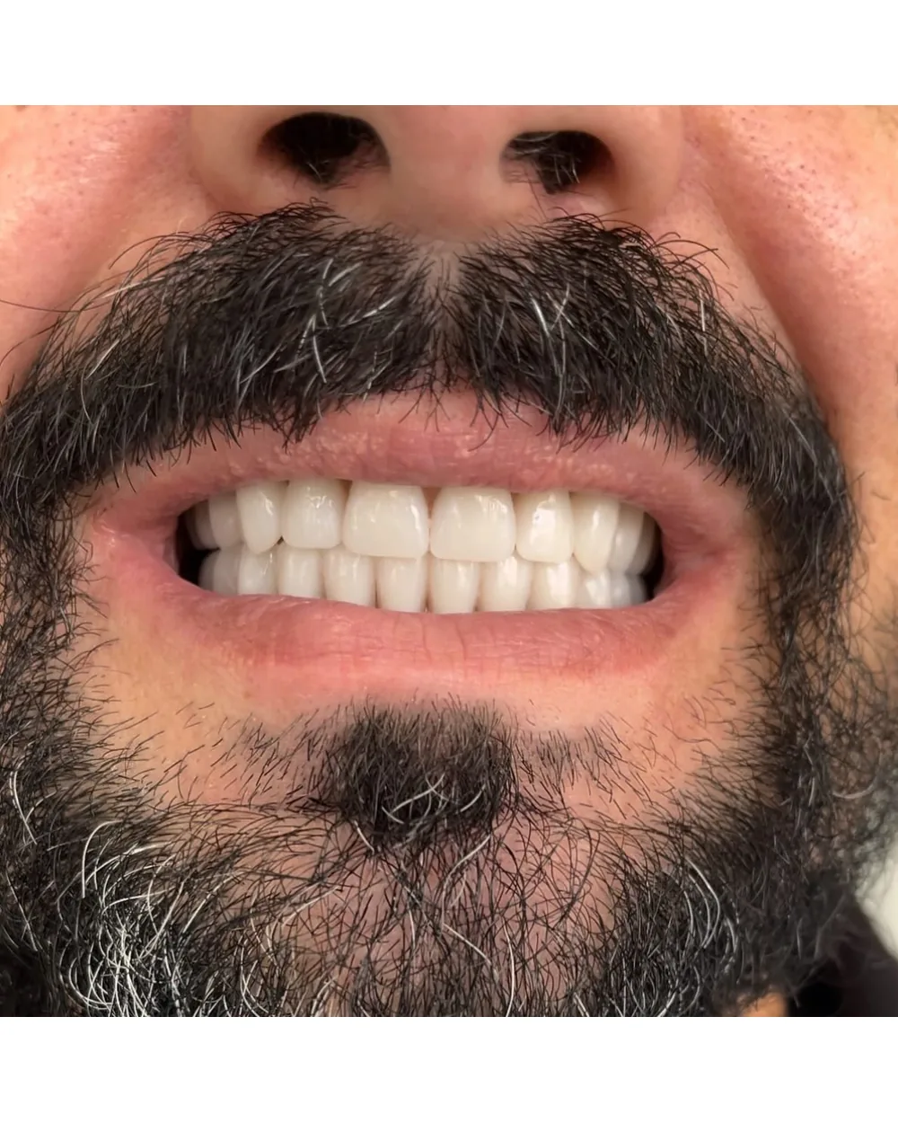 Paciente sorrindo após a reabilitação do sorriso