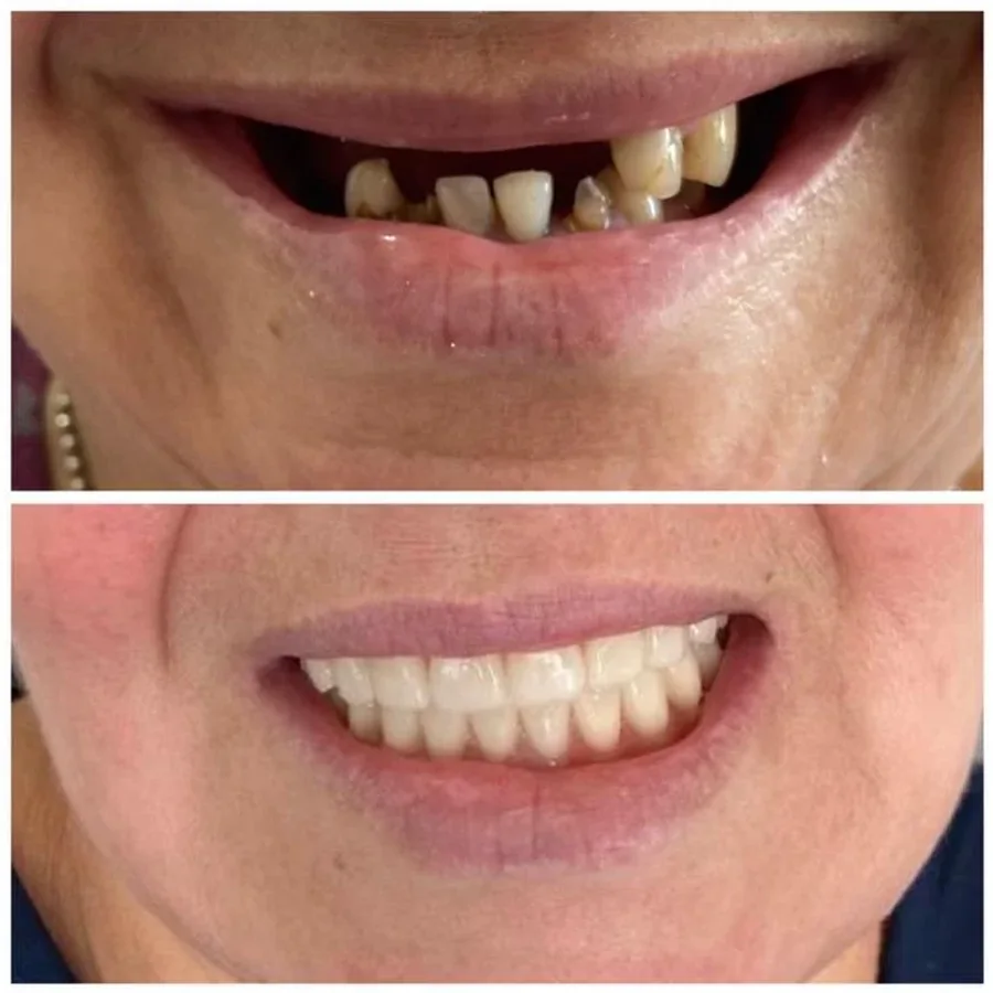 Antes e depois de paciente reabilitado com dentes fixos pelo Dr. Rogério Bertevello